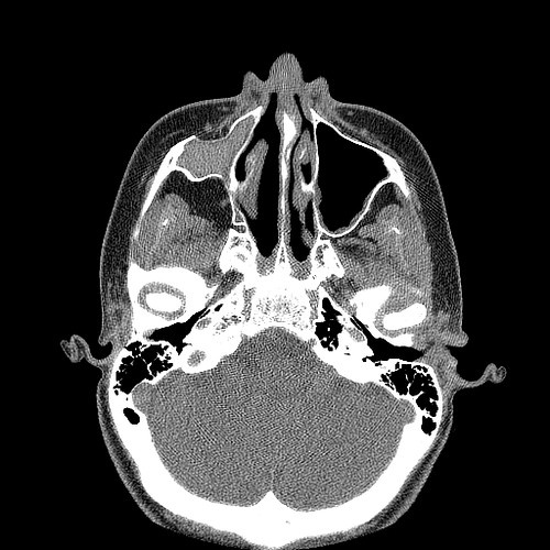 ct scan